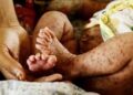দেশে হামের উপসর্গে আরও ৮ শিশুর মৃত্যু